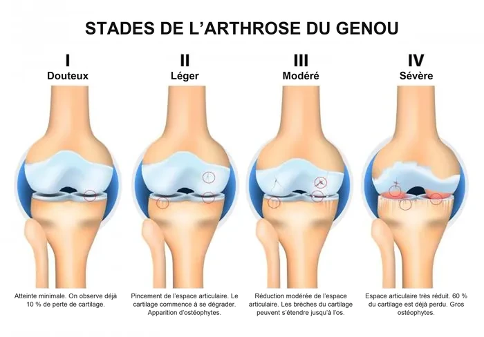 Prise en charge de la douleur liée à l’arthrose et à l’arthrite à Active Health Clinic, Beyrouth