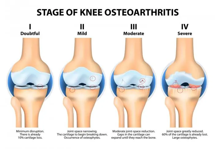 Arthritis pain management at Active Health Clinic, Beirut
