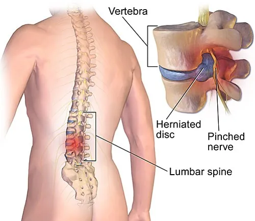 Low back pain treatment, osteopathy, Beirut, Lebanon